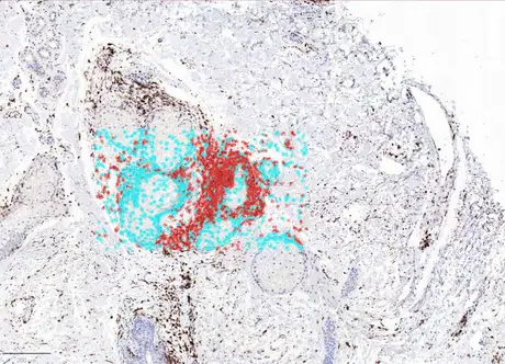 TRBC1/CD3 Ratio
