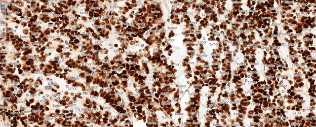 ER IHC stain