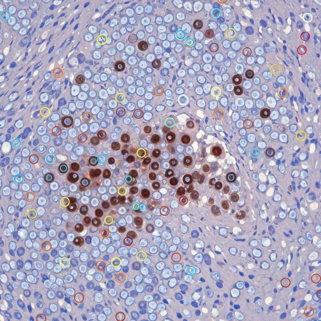 p53 IHC stain