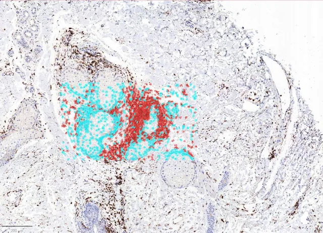TRBC1 / CD3 IHC stain